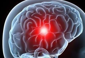 Un casque pour prévenir les lésions cérébrales chez les personnes victimes d'un AVC