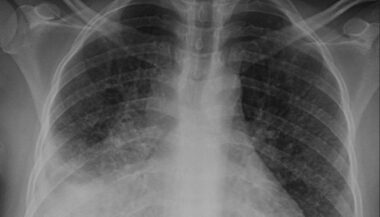 Plus de 30.000 cas de tuberculose au Maroc en 2016