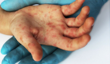 Médecine: La rougeole à l'origine d'une amnésie immunitaire ?
