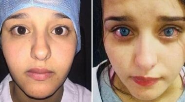 Changer la couleur des yeux est-il vraiment sans risque?