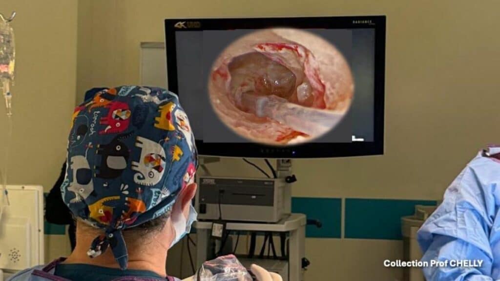 implantation cochléaire réalisée sous guidage endoscopique
